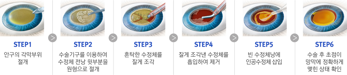 백내장 수술 과정