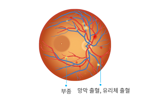 비증식 당뇨망막병증