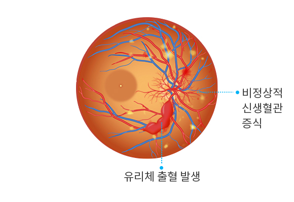 증식 당뇨망막병증