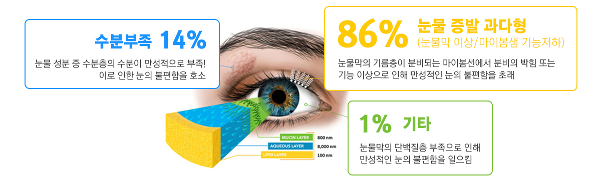 안구건조증 종류