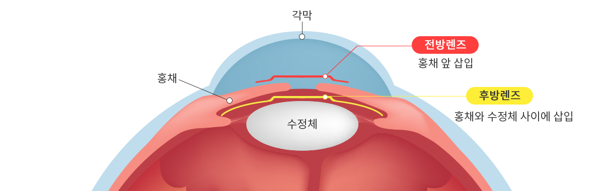 안내렌즈삽입술이미지