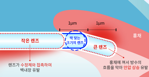 딱맞는렌즈삽입