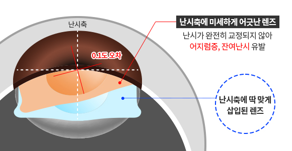 난시축에 맞춰 정확하게 삽입