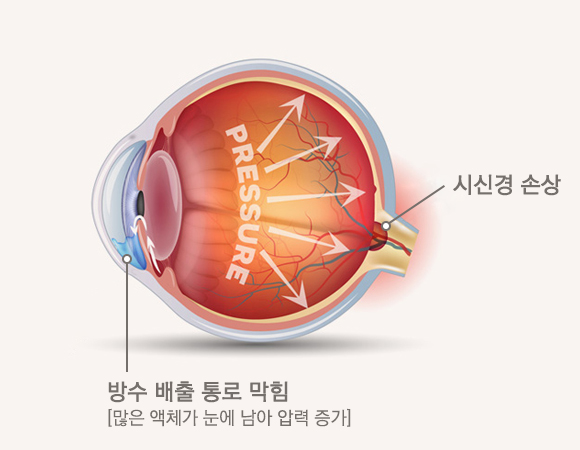 녹내장안구이미지