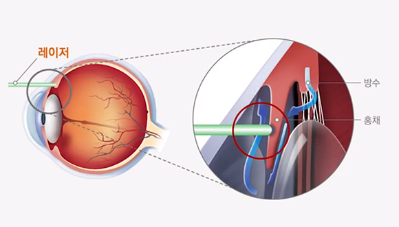 레이저 홍채절개술