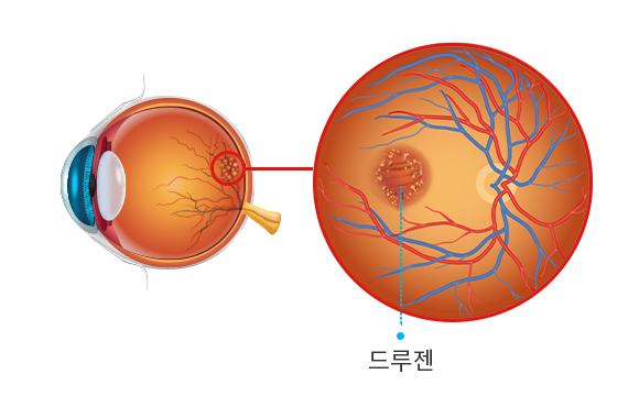 비삼출성 건성 황반변성