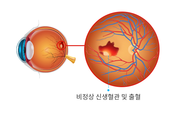 삼출성 습성 황반변성