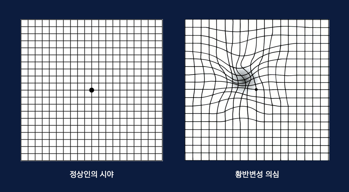 암슬러 테스트 결과