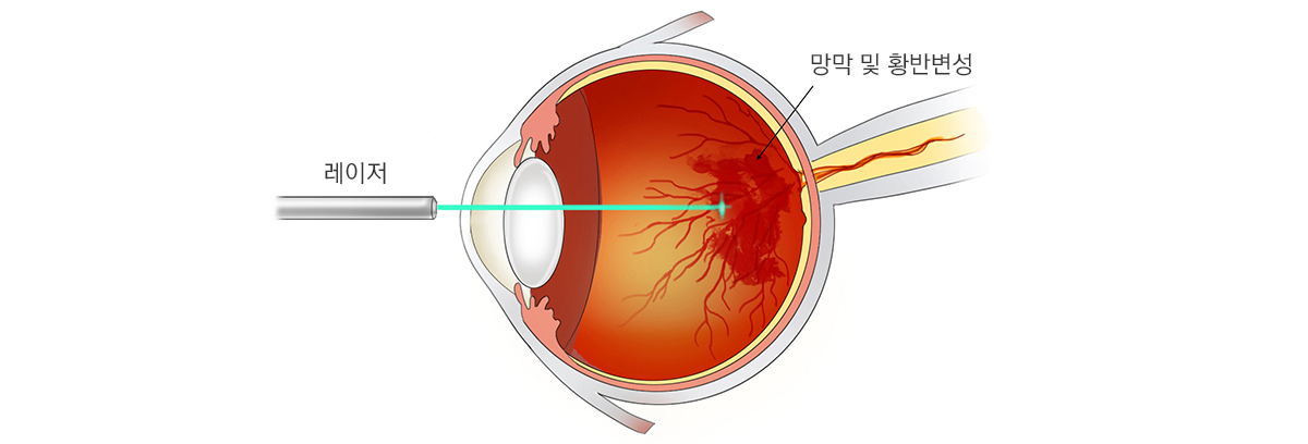 광역학레이저치료(PDT)