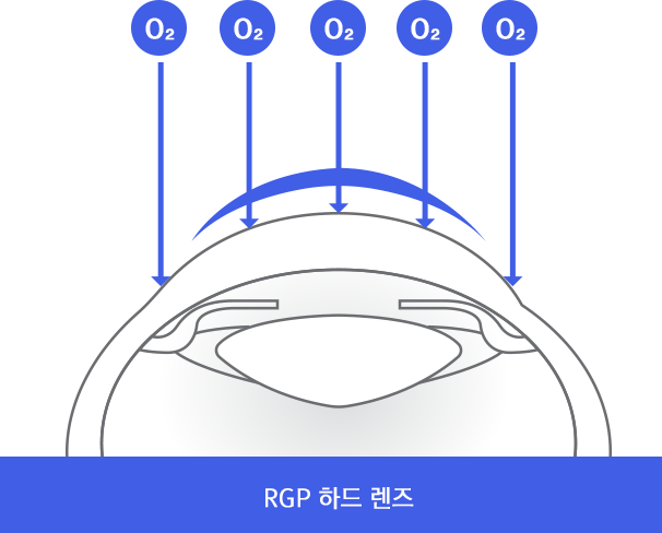 하드렌즈이미지